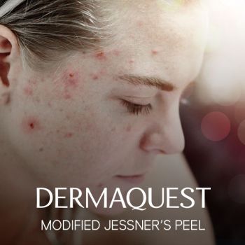 DermaQuest Modified Jessner’s Peel / The Equaliser