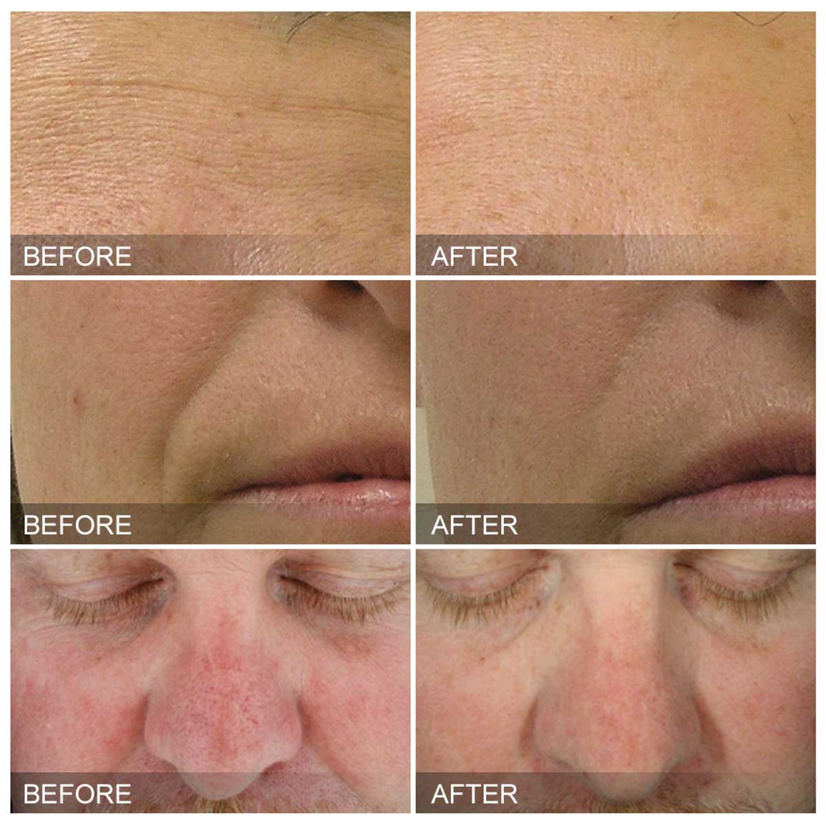 hydrafacial-before-after
