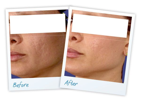laser acne treatment results