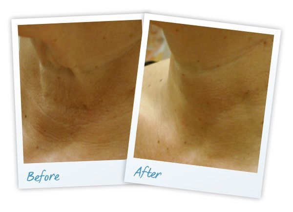 laser anti ageing results