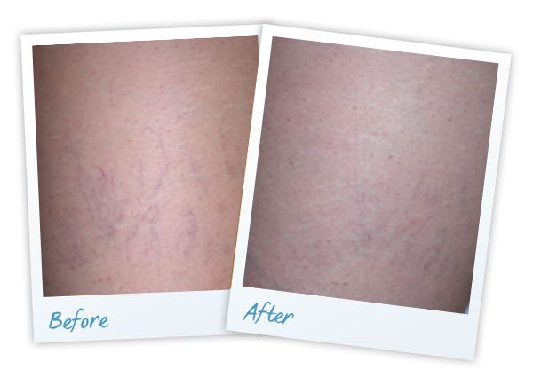 laser vein treatment results